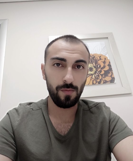 Caglar Genceldi before his hair transplant