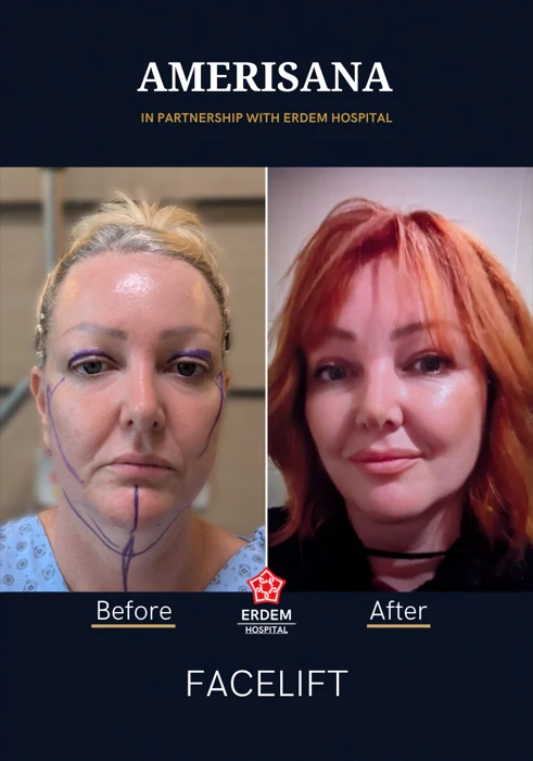 Facelift before and after, in partnership with Erdem Hospital