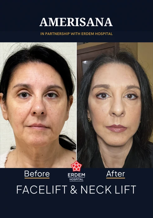 Facelift & neck lift before and after, in partnership with Erdem Hospital